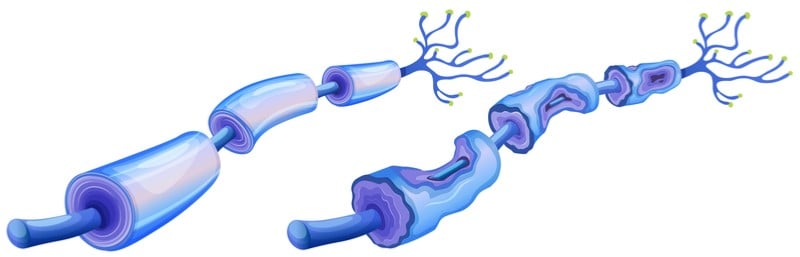 polyneuron anti-mag peripheral neuropathy autoimmune disease