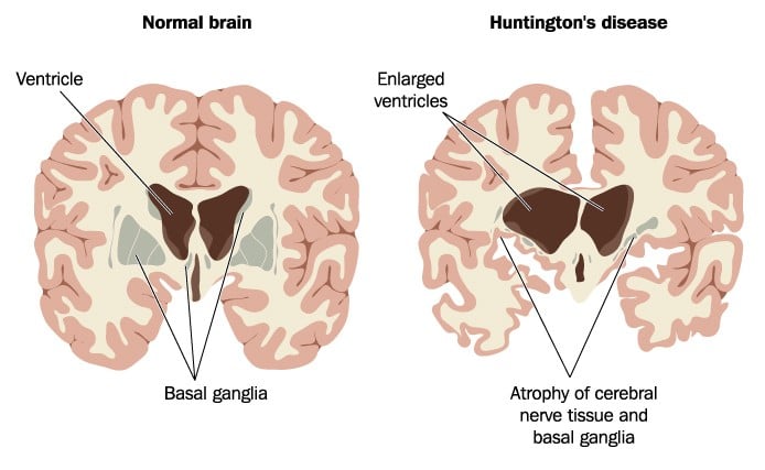 som biotech huntington's disease repurpose amyloidosis brain