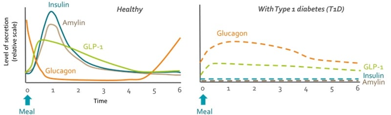 type 1 diabetes insulin glucagon amylin