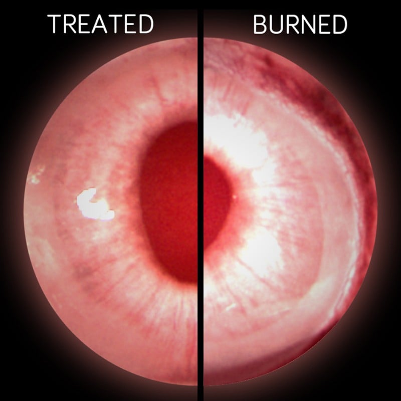 chemical burns cornea university of newcastle stem cells