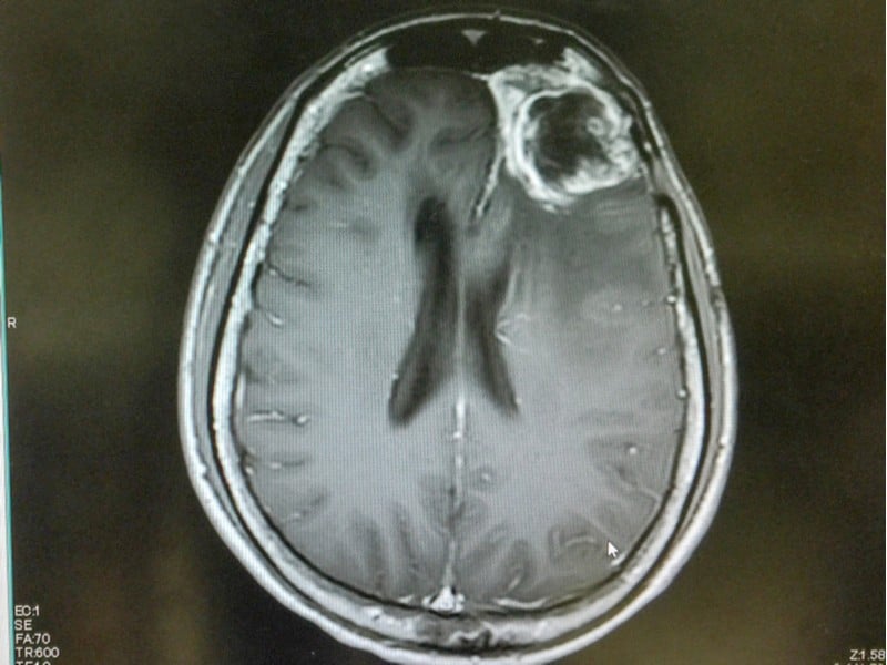 cancer treatment glioblastoma aacr