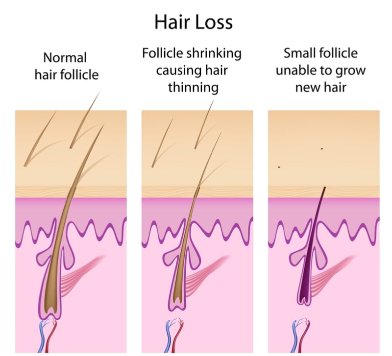 cassiopea baldness hair loss follicle