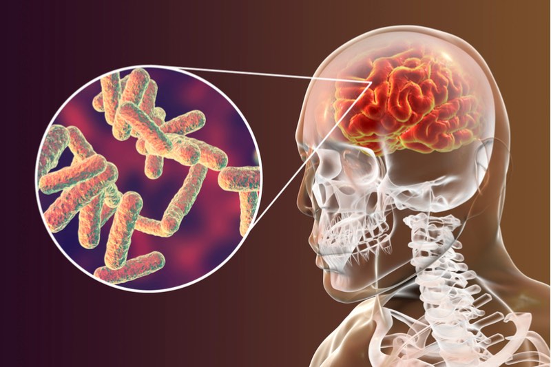 meningitis antibiotic resistance sweden