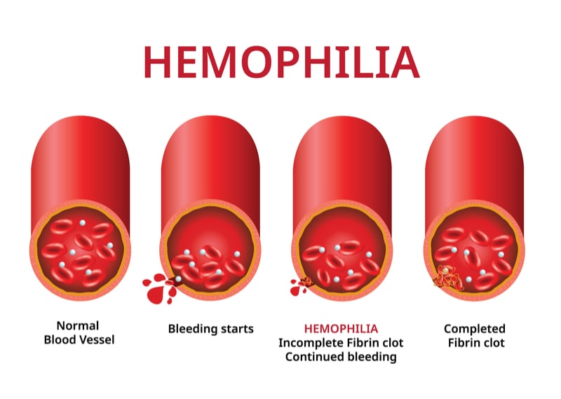 First Potential Gene Therapy for Hemophilia B Restores Blood Clotting in  Phase II