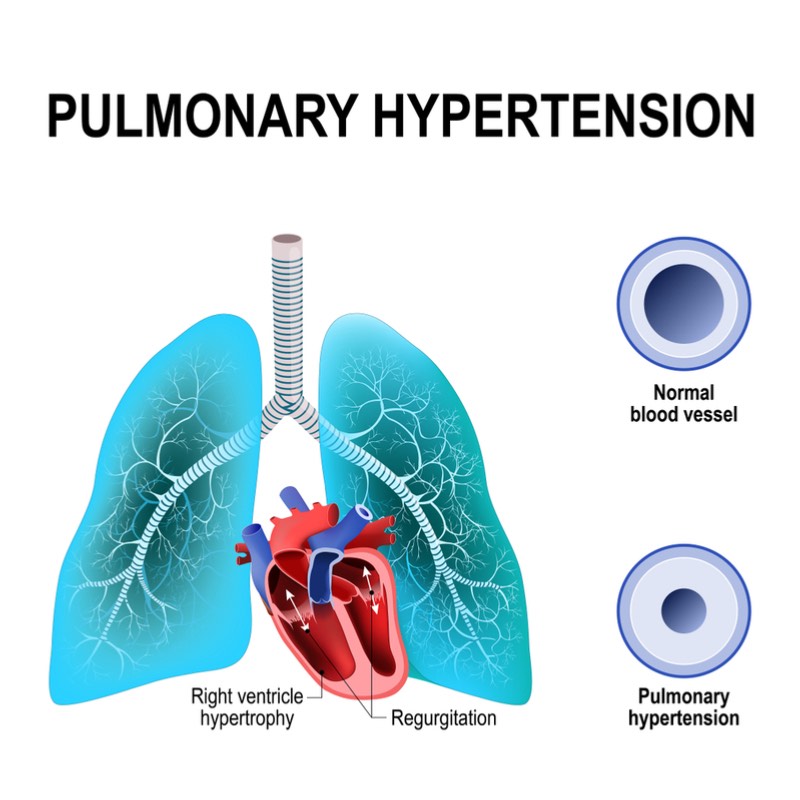 owlstone medical pulmonary hypertension heart failure