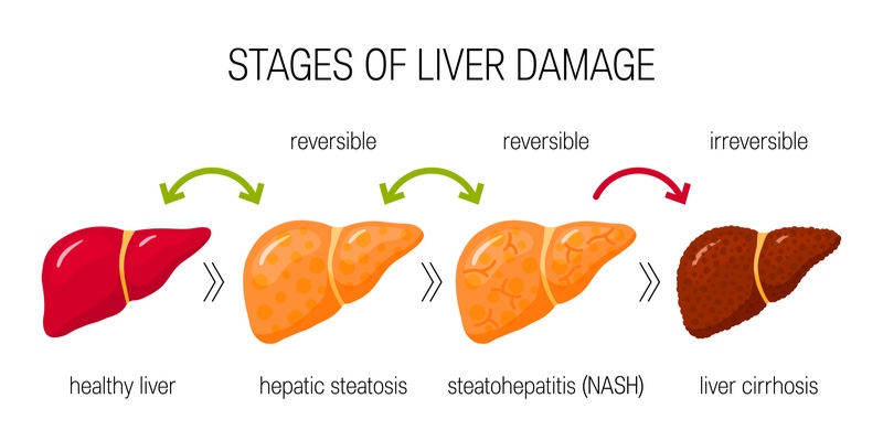 nash genfit liver fibrosis terns pharmaceuticals