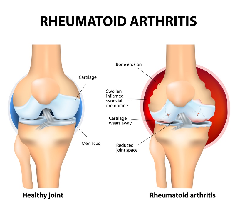 galapagos gilead rheumatoid arthritis pulmonary fibrosis