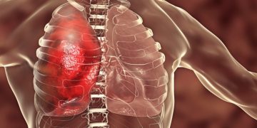 pneumonia polyphor antibiotic murepravadin