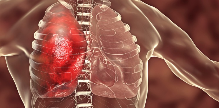 pneumonia polyphor antibiotic murepravadin