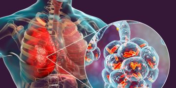 Nabriva story - bacterial pneumonia antibiotic