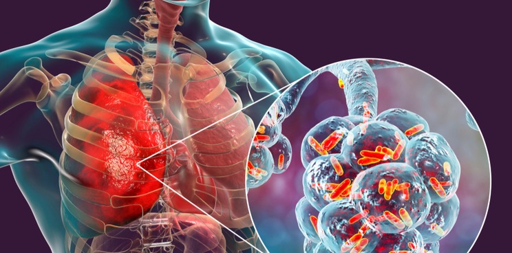 Nabriva story bacterial pneumonia antibiotic