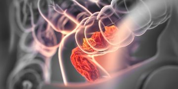 colorectal cancer mologen cancer immunotherapy