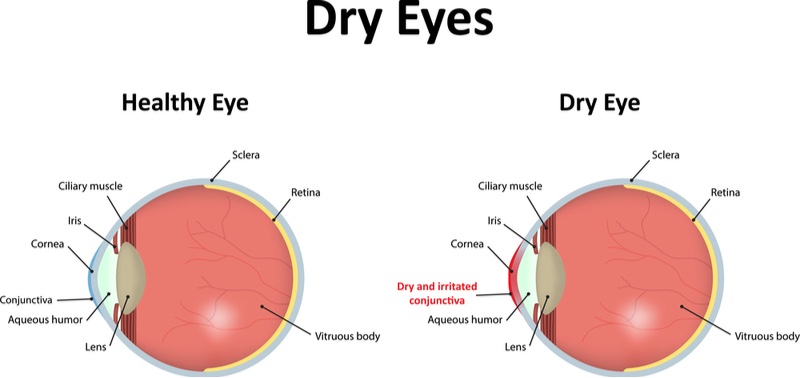 topivert dry eye disease syndrome