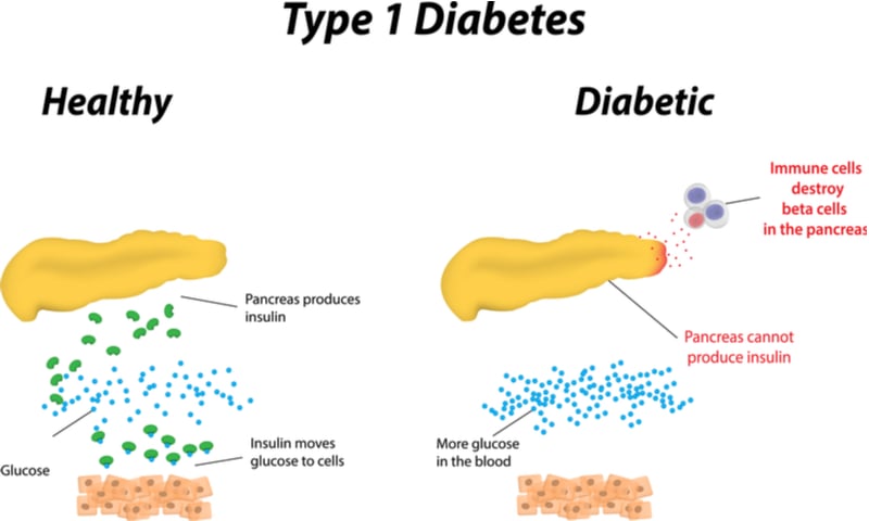 type 1 diabetes imcyse immunotherapy