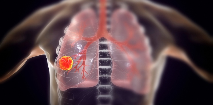 breathomix breath diagnostics lung cancer