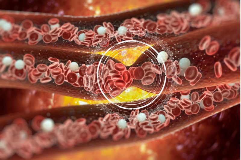 cardiovascular disease heart attack blood clot