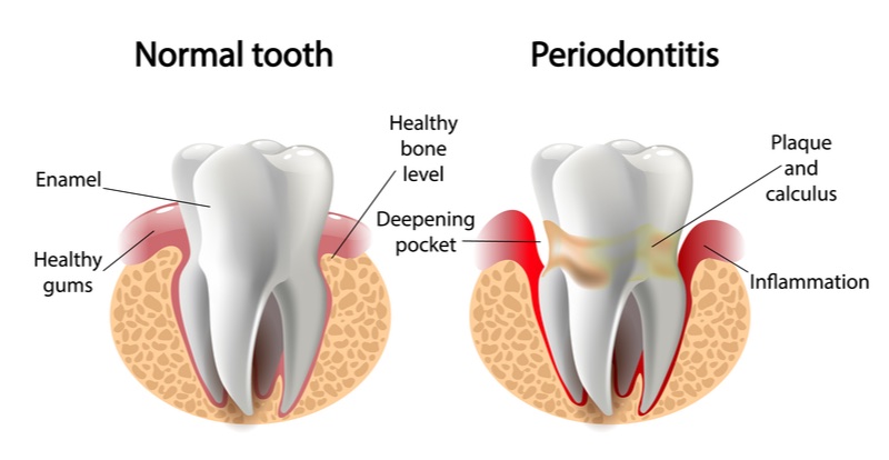 periodontitis omnio sweden tooth loss