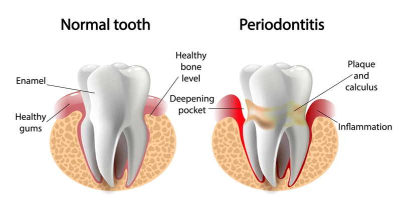 periodontitis omnio sweden tooth loss