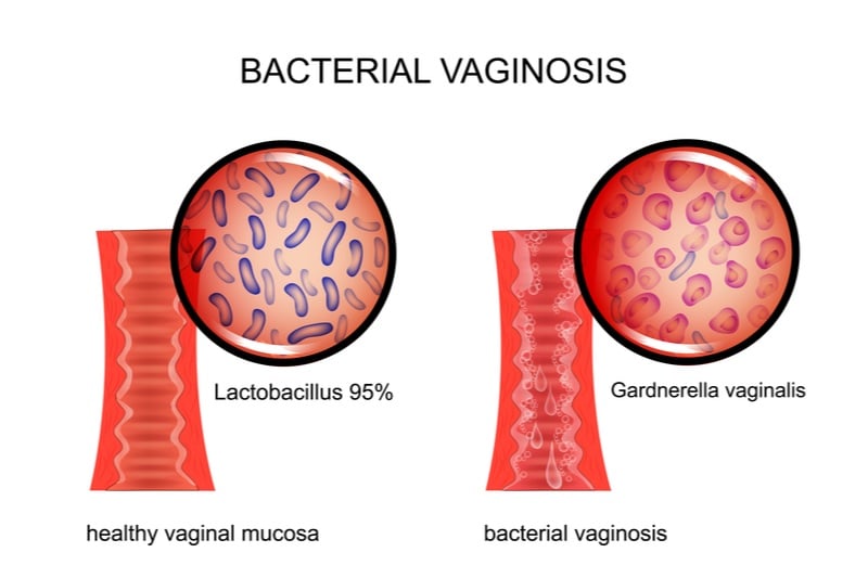 bacterial vaginosis phagomed biopharma gardnerella