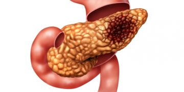 Personalized vaccine pancreatic cancer