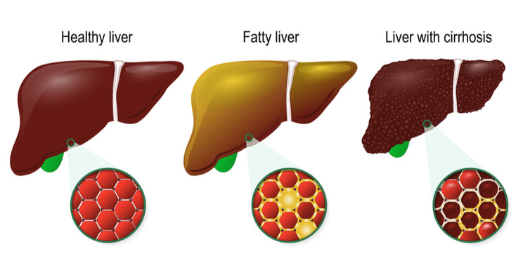 stages of liver damage, NASH, fibrosis, cirrhosis