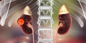 kidney cancer elypta sweden