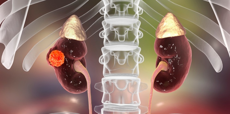 kidney cancer elypta sweden