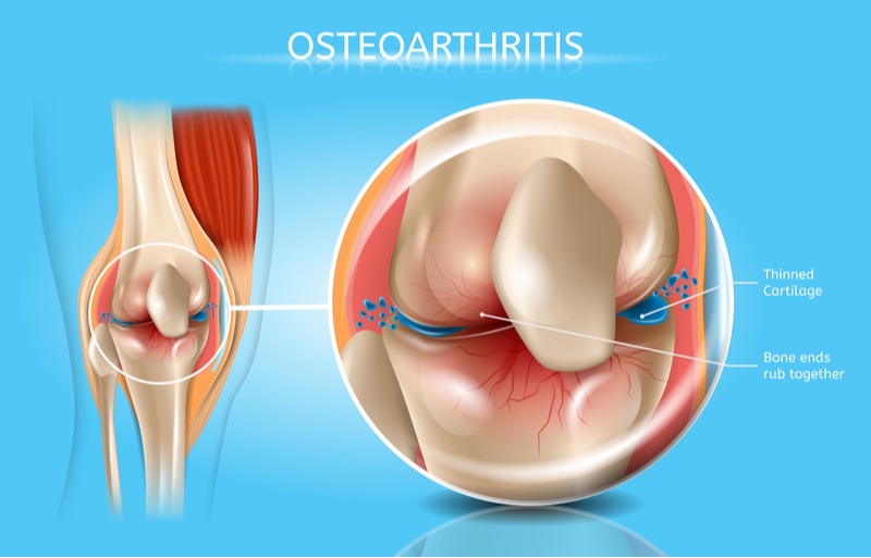 unity biotechnology anti-aging osteoarthritis