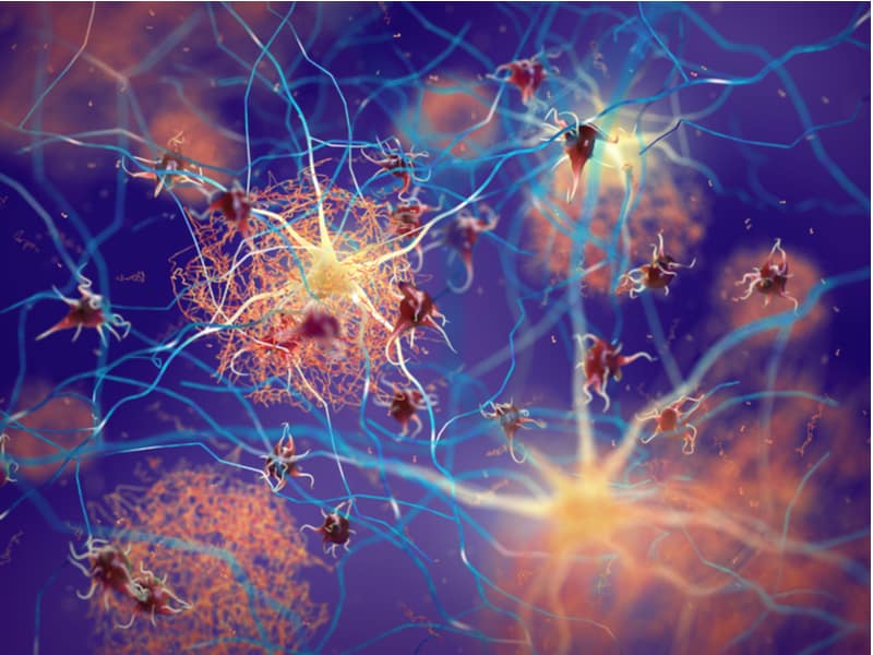 alzheimers disease biogen amyloid aducanumab