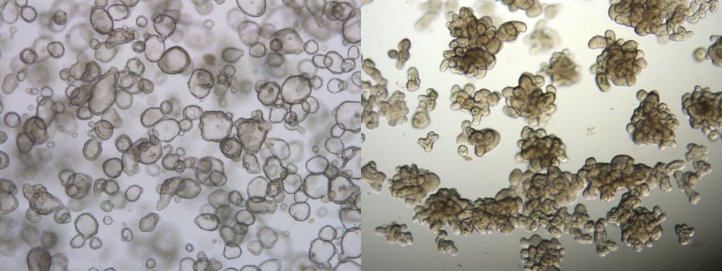 organoid-era-bringing-patient-relevant-preclinical-models-to-lab healthy and diseased cystic fibrosis organoids