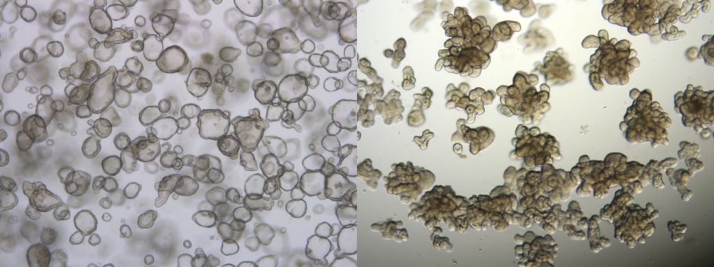 healthy and diseased cystic fibrosis organoids