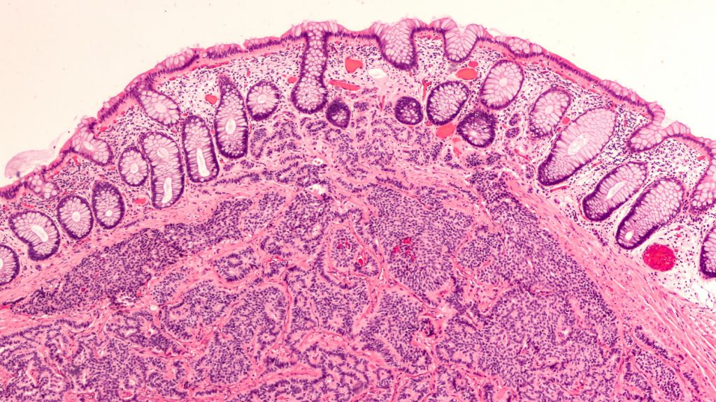 neuroendocrine tumor