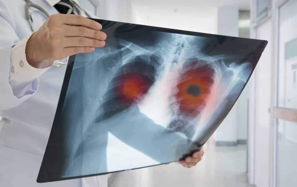 shutterstock lung cancer