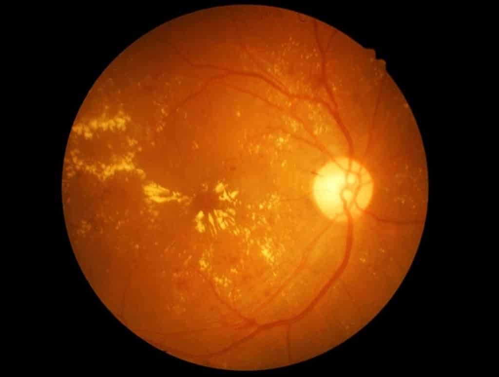 shutterstock macular degeneration