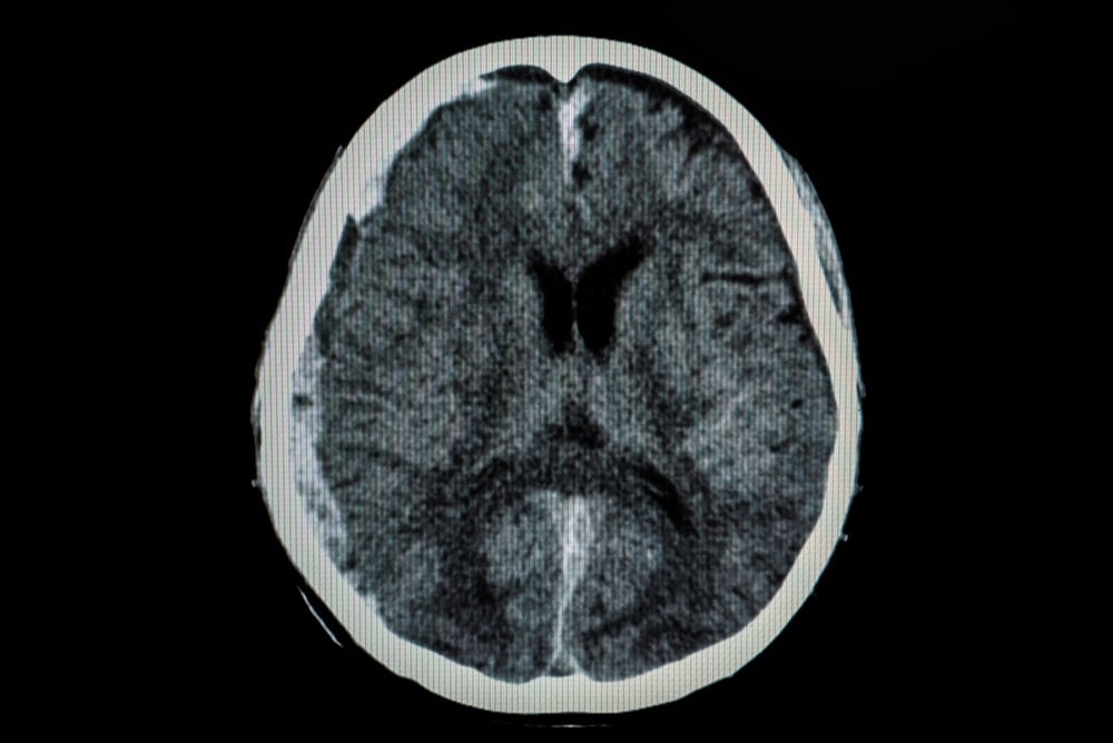 brain injury