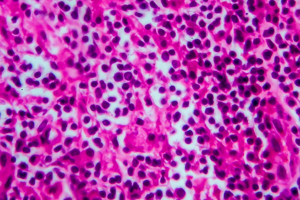 Marginal zone lymphoma