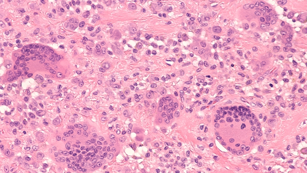 giant cell tumour tumor