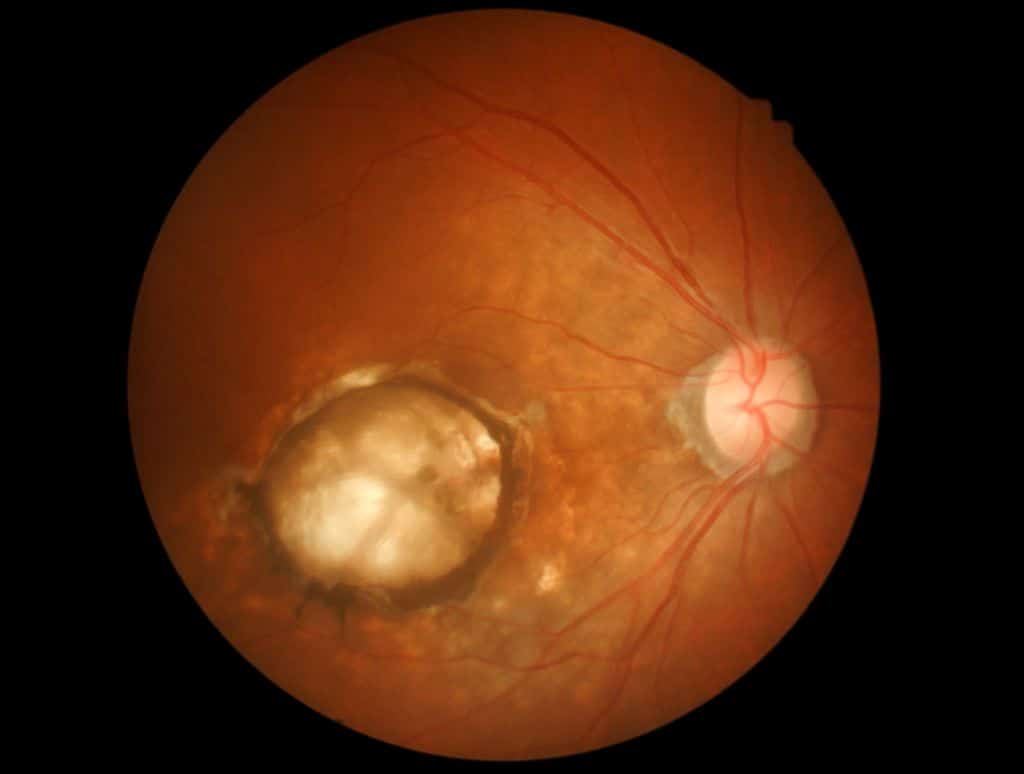 shutterstock macular degeneration