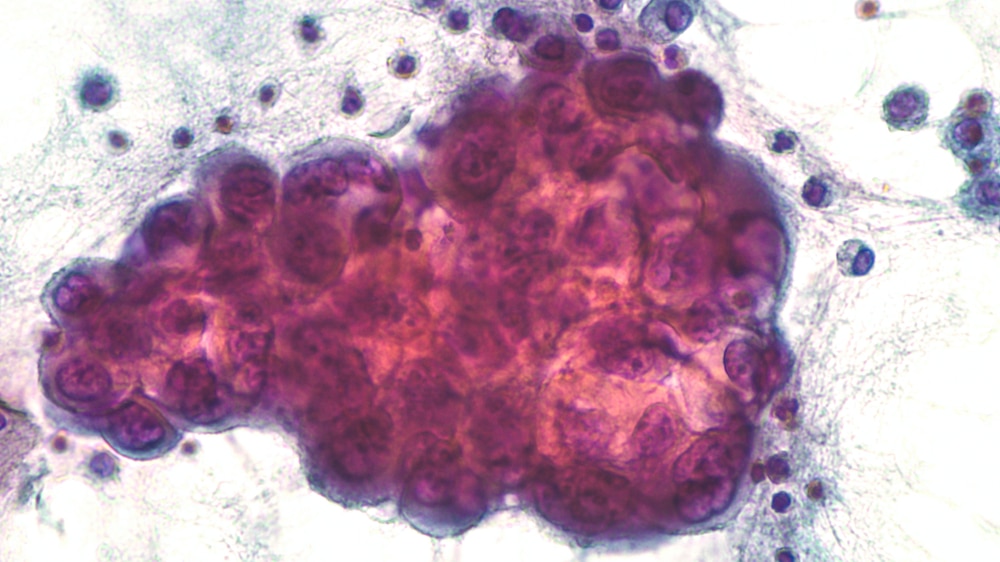 non-small cell lung cancer NSCLC