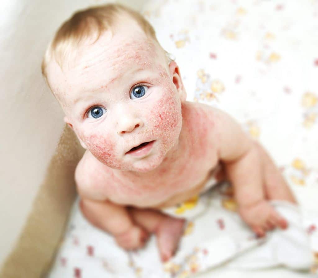 shutterstock child atopic dermatitis