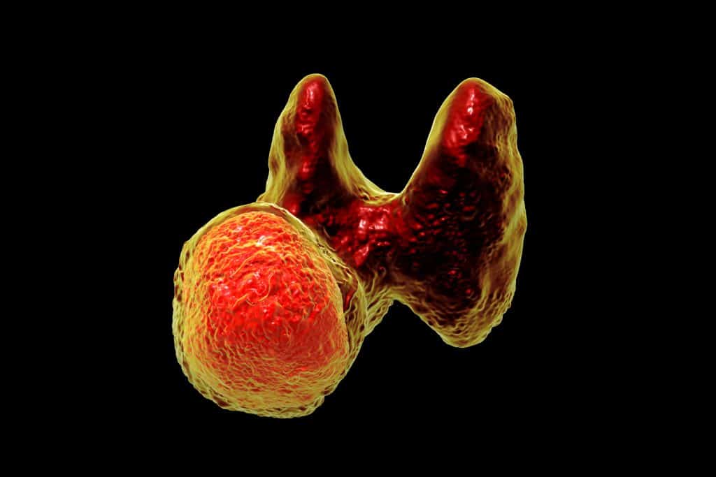 shutterstock larynx carcinoma