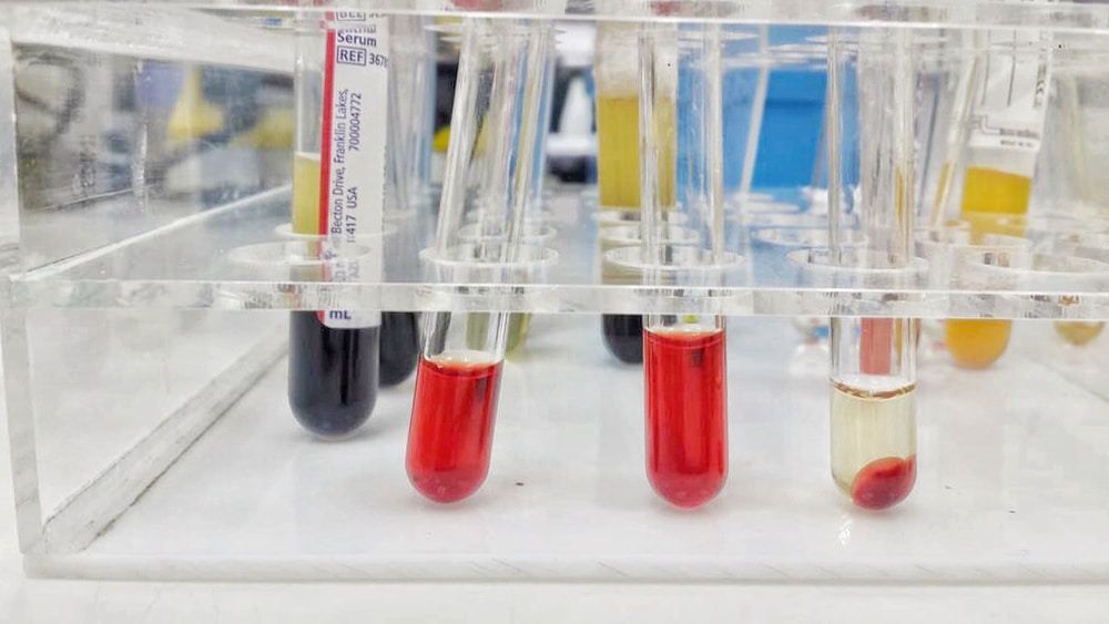 paroxysmal nocturnal hemoglobinuria