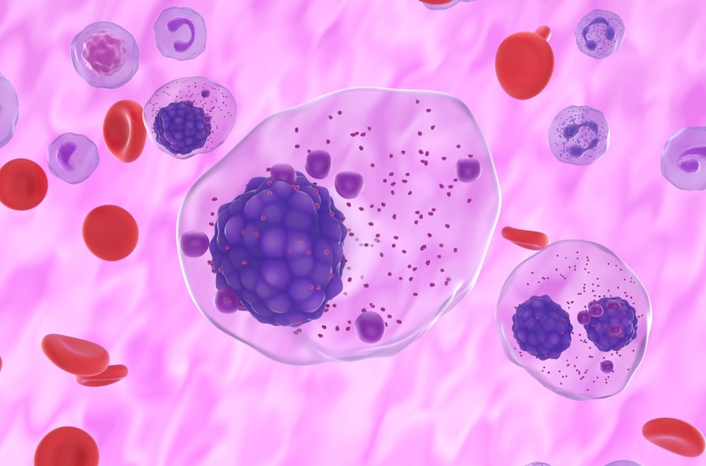 multiple myeloma