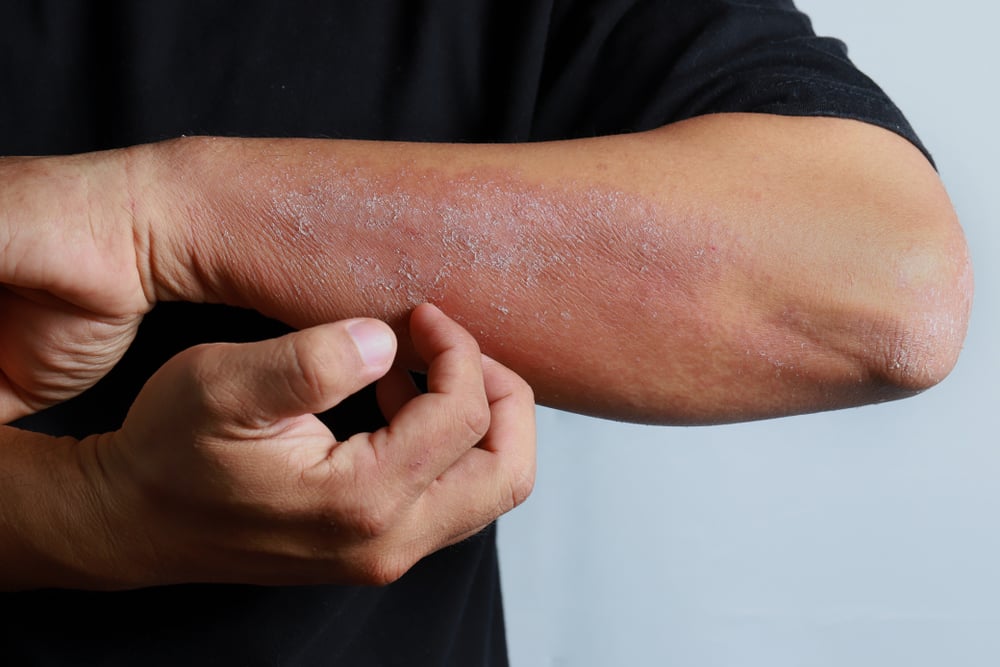 dermatology eczema