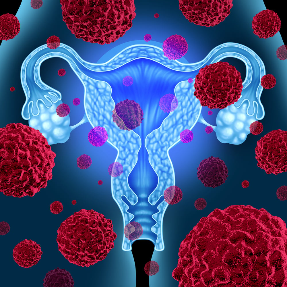 Localisation des mutations du gène BRCA pour améliorer le traitement du cancer de l’ovaire