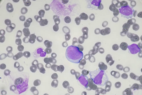 acute myeloid leukaemia leukemia AML