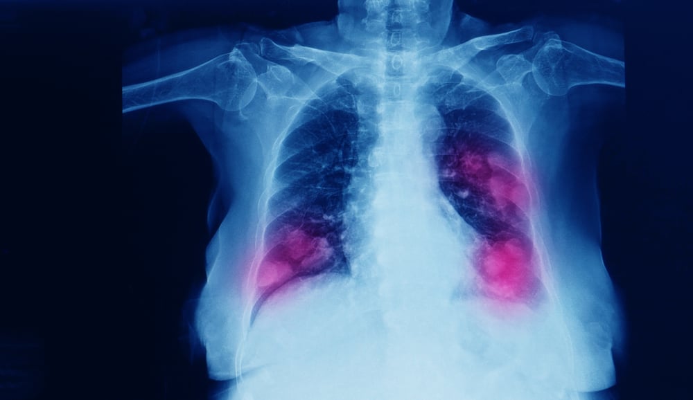 lung cancer