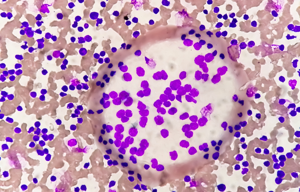 leukaemia leukemia