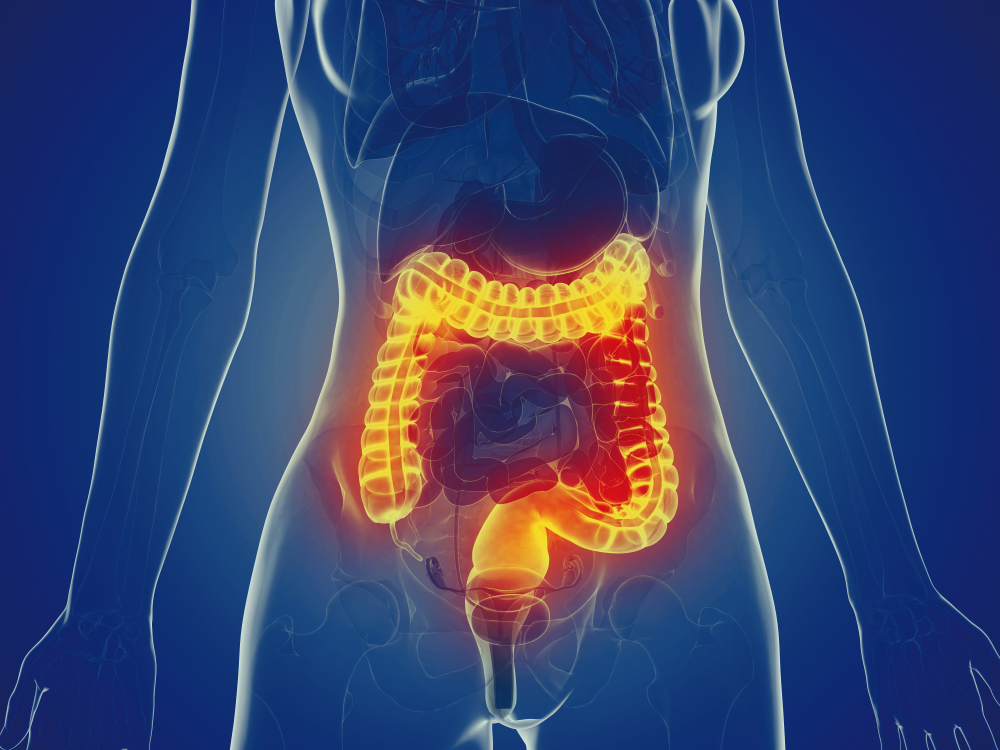 inflammatory bowel disease