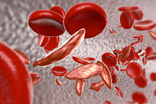 sickle cell disease